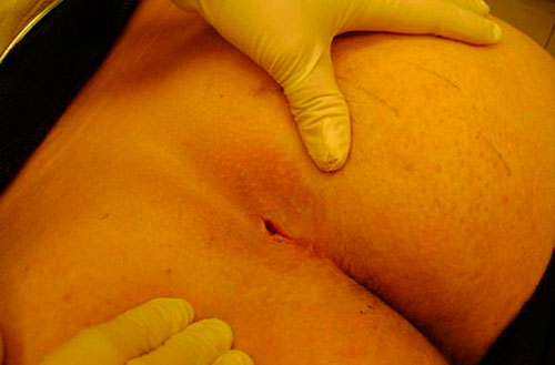 Показания и противопоказания к операции удалению копчикового хода