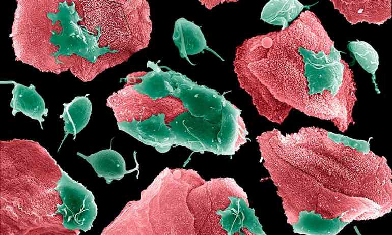 Трихомониаз распознай и победи!