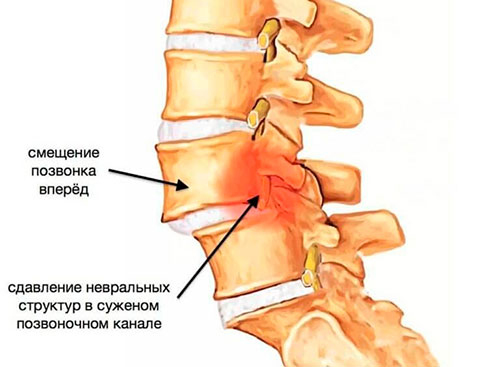 Смещение позвоночника-спондилолистез