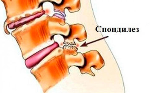 Симптомы спондилеза поясницы