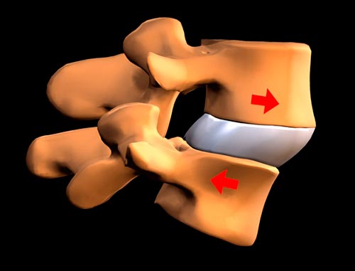 Антеспондилолистез позвоночника