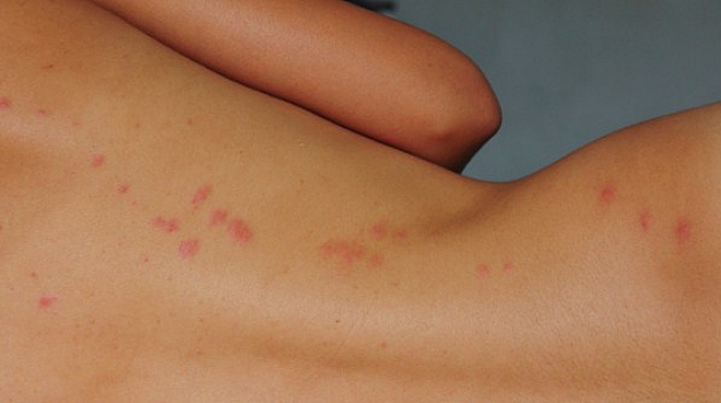 укус клопа на спине