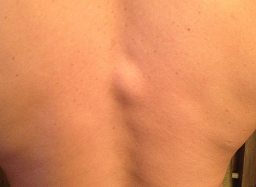 Симптомы кисты позвоночника