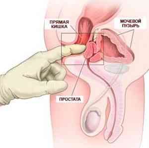 Как снизить боли при простатите?
