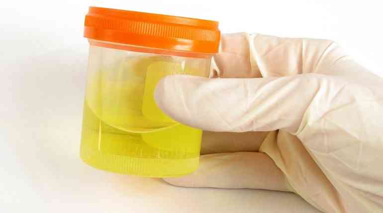 Мутная история: почему мутнеет моча и опасно ли это?