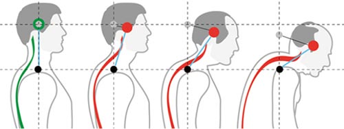 Лордоз шейного отдела