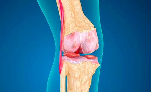 Артроз коленного сустава