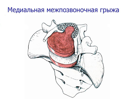 Что такое медианная грыжа позвоночника