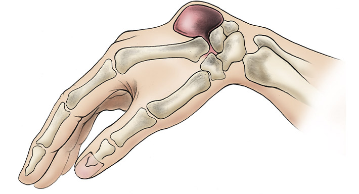 Гигрома запястья что это такое? Симптомы, причины возниковения и лечение