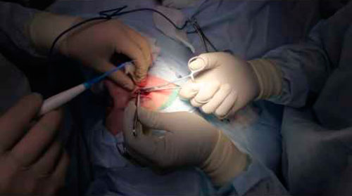 Операция кисты позвоночника