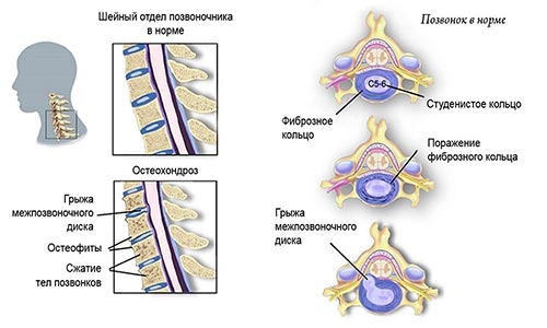 Что такое нарушение статической функции позвоночника?