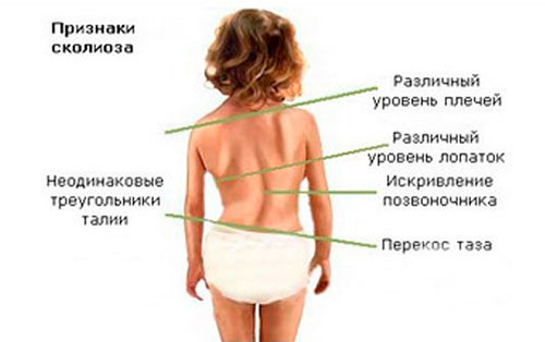 К какому врачу обратиться при сколиозе?