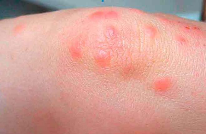 укус от клопа