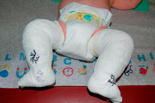 Гипсование конечностей при артрогрипозе