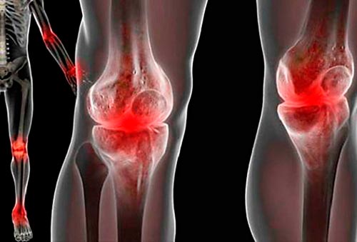 Виды артрита