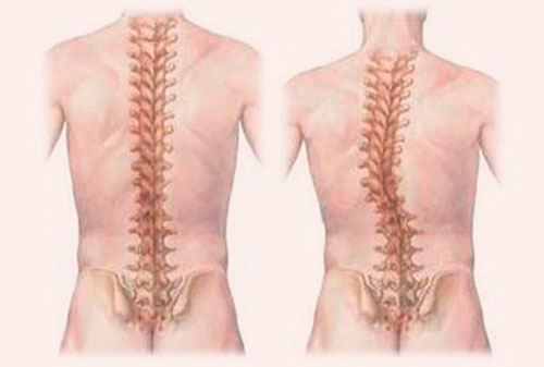 Что такое сколиоз?