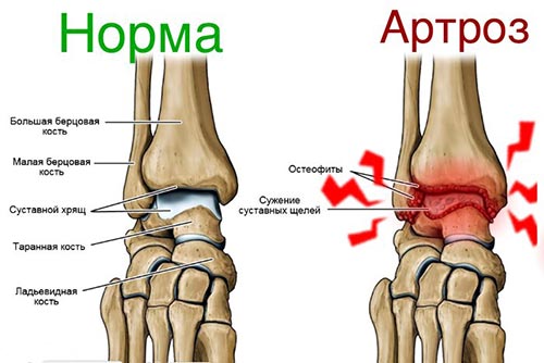 Артроз таранно-ладьевидного сустава