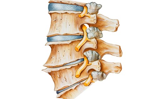 Симптомы и лечение артрита позвоночника