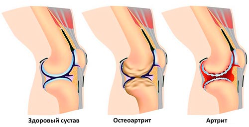 Степени артрита