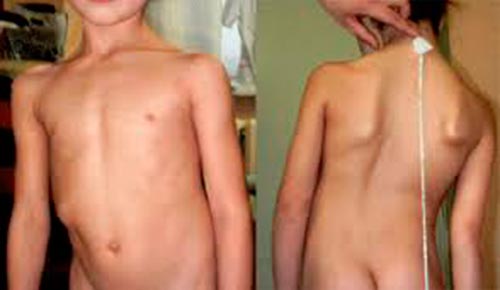 Симптомы миелодисплазии