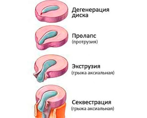 Развитие грыжи позвоночника