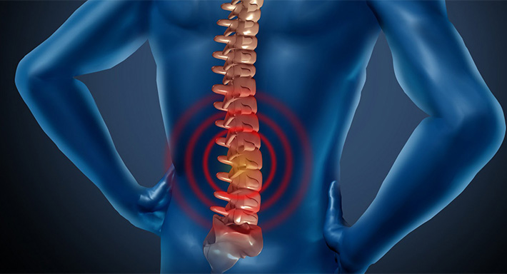 Что такое спондилез позвоночника: симптомы, лечение, профилактика