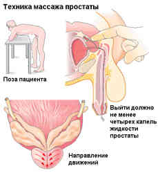 Проблемы мочеиспускания при простатите