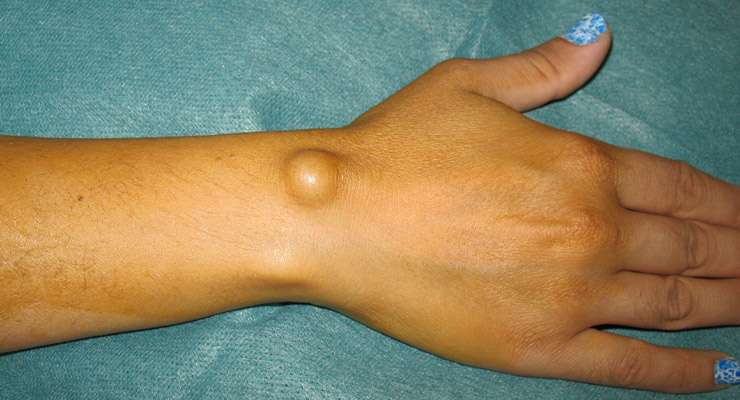 Что такое гигрома запястья Что такое гигрома запястья