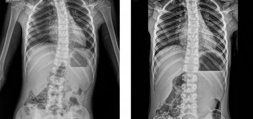 Рентген при сколиозе