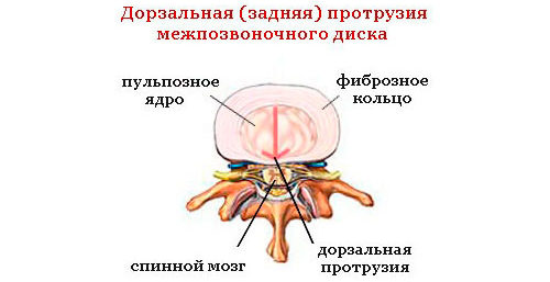 Что такое дорзальная диффузная грыжа межпозвонкового диска и ее причины