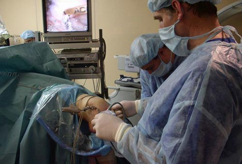 Операция при гонартрозе