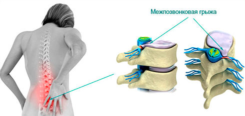 Как появляется боль при грыже позвоночника?