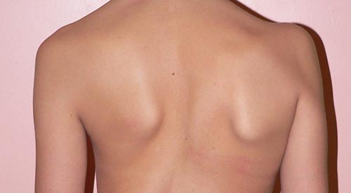 Берут ли в армию со сколиозом?