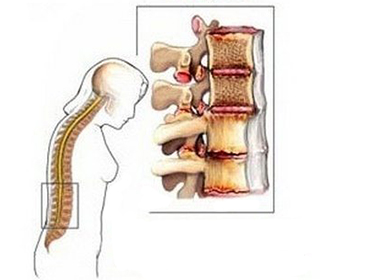 Болезнь Бехтерева