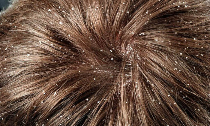 seboreya Что такое себорея и как это лечить?