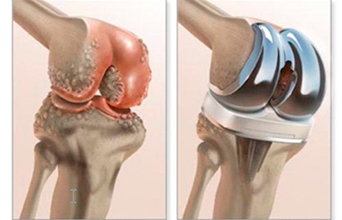 Искусственный сустав