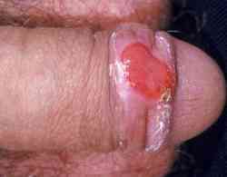 Красные пятна и точки на головке члена: отчего они появляются и как вылечиться?