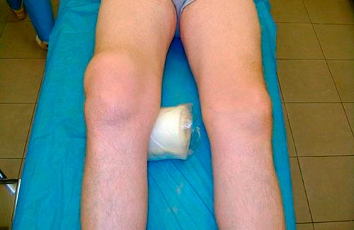 Отек колена