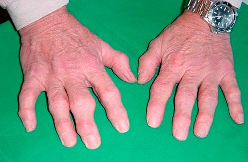 Артрит пальцев рук