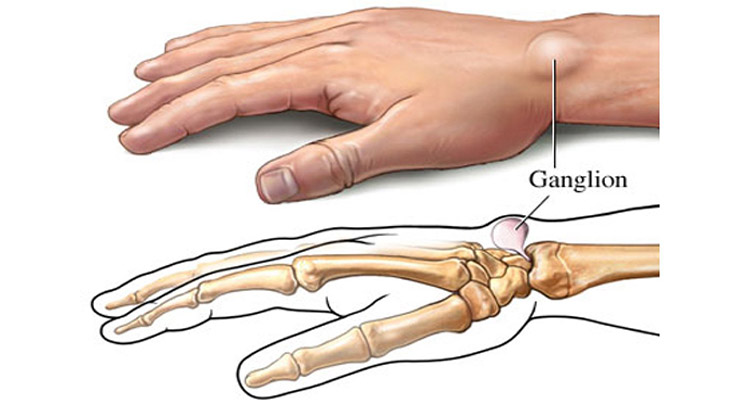 Симптомы гигромы Симптомы гигромы