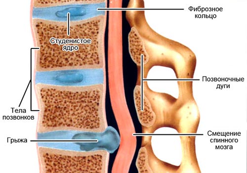 Что такое грыжа крестцового отдела?