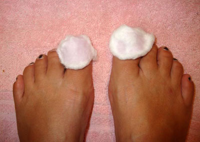 Ватные диски с лекарством на ногтях Ватные диски с лекарством на ногтях