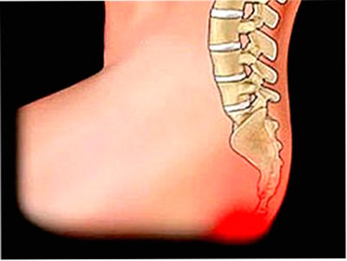 Смещение копчика из-за травмы