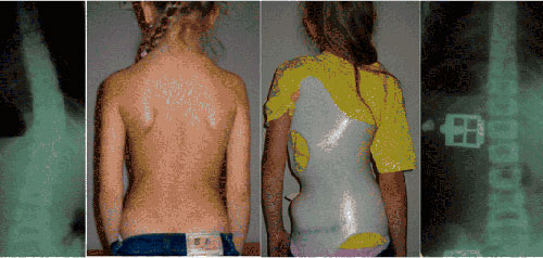 Корригирующий корсет