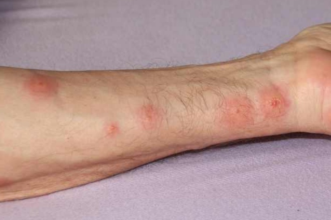укус клопа на руке