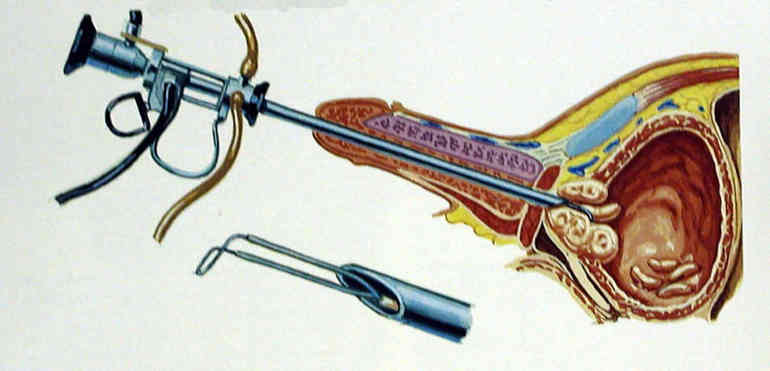 Как проходит трансуретральная резекция аденомы простаты?