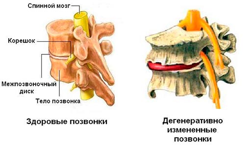 Дегенеративно-дистрофические изменения грудного отдела позвоночника