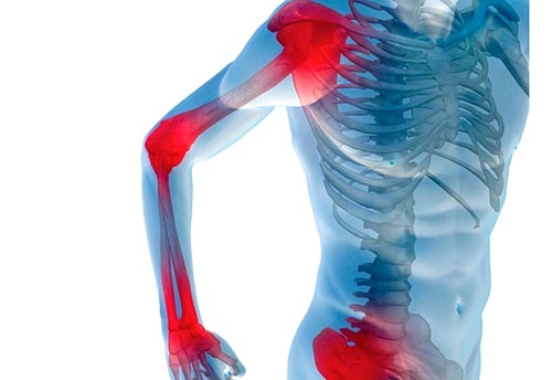 Блуждающий артрит