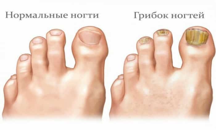 dejstvennye-sposoby-lecheniya-gribka-nogtej-stop-v-domashnikh-us-l71506973559 Диагностика и лечение микоза ногтей