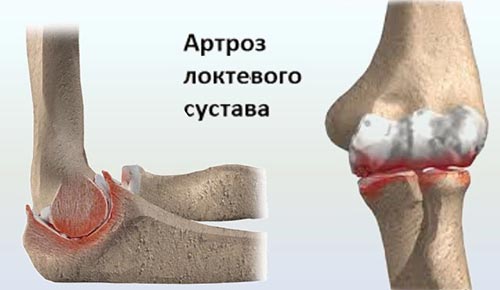Артроз локтевого сустава